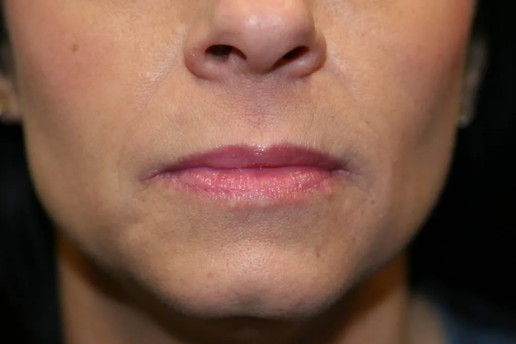 After Lip Enhancement