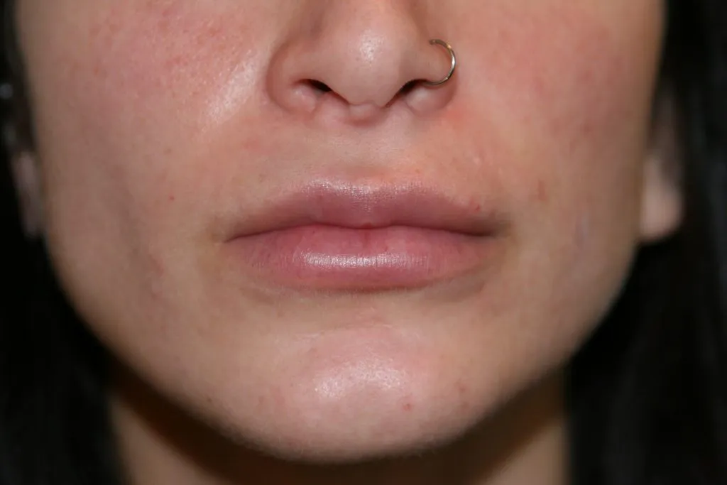 After Lip Enhancement