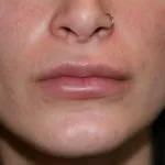 After Lip Enhancement