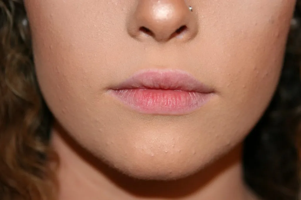 Before Lip Enhancement