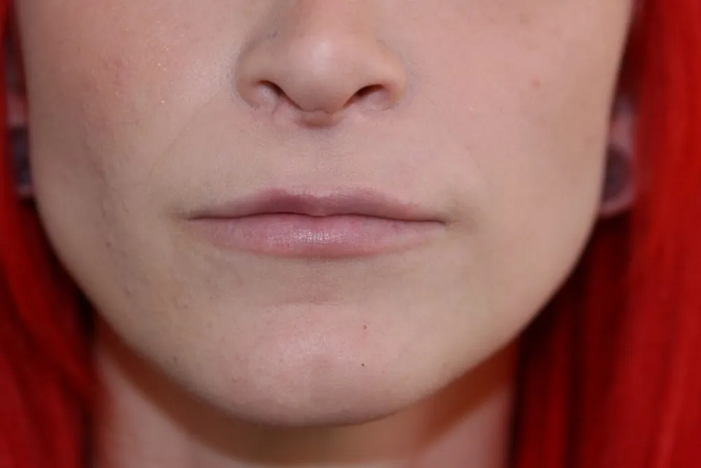 Before Lip Enhancement