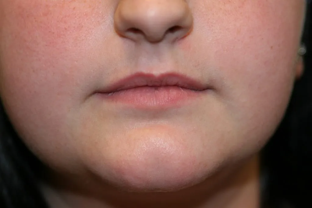 Before Lip Enhancement