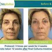Before and after Celluma Led Therapy