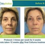 Before and after Celluma Led Therapy 