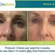 Before and after Celluma Led Therapy 