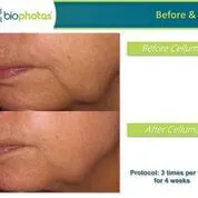 Before and after Celluma Led Therapy