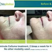 Before and after Celluma Led Therapy