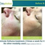 Before and after Celluma Led Therapy 