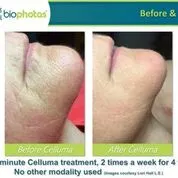Before and after Celluma Led Therapy