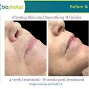 Before and after Celluma Led Therapy