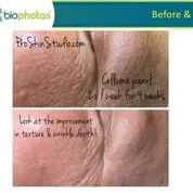 Before and after Celluma Led Therapy