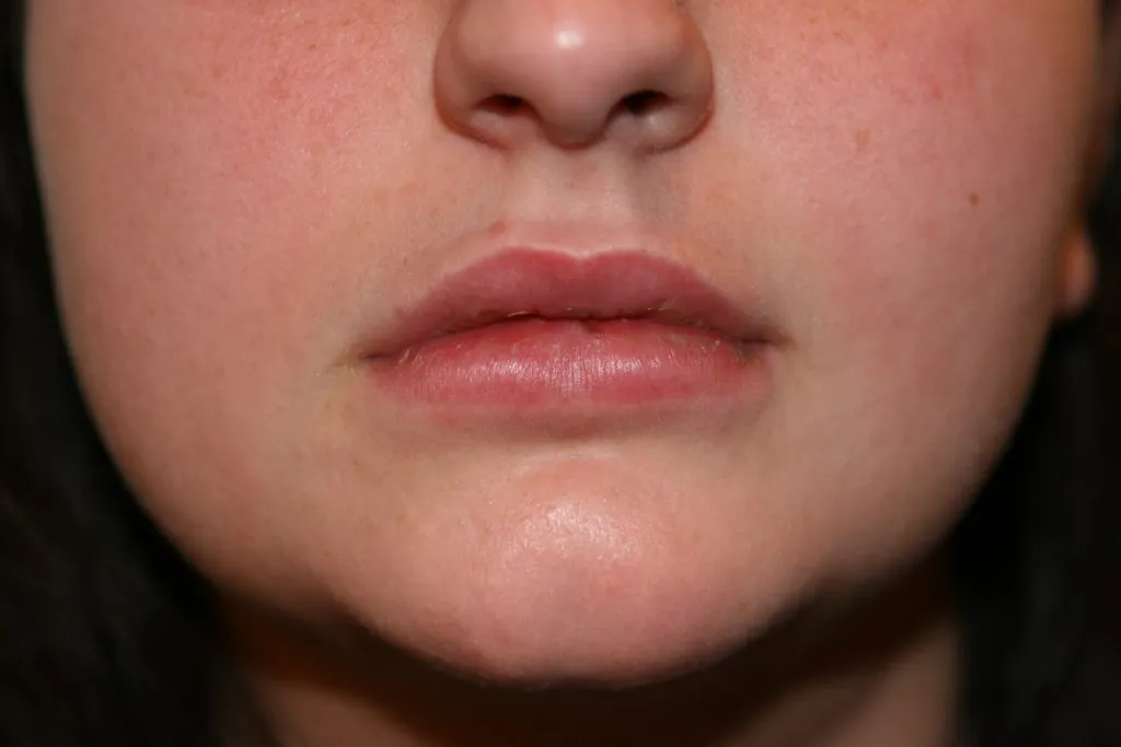 After Lip Enhancement
