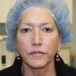 Before 4 Lid Eyelid Lift