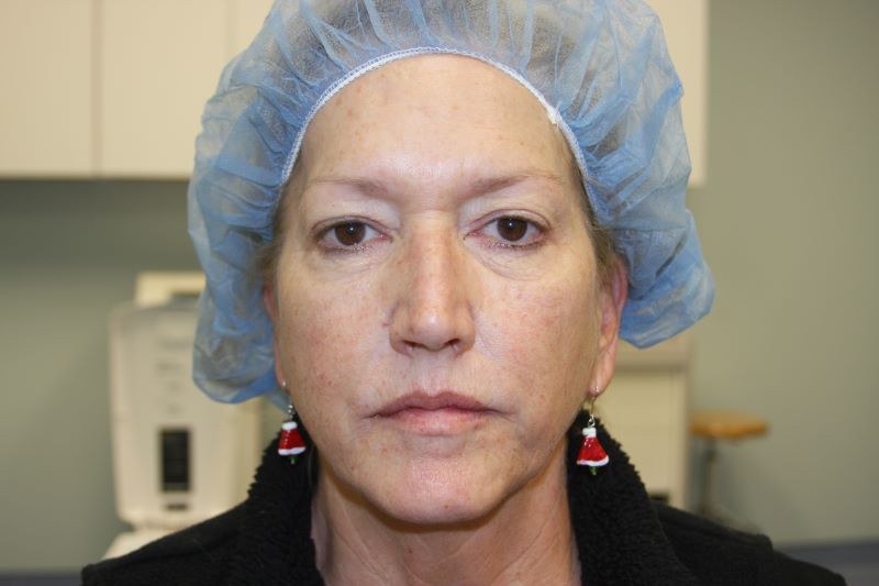 Before 4 Lid Eyelid Lift