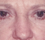 After 4 Lid Eyelid Lift
