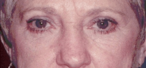 After 4 Lid Eyelid Lift