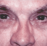 After 4 Lid Eyelid Lift
