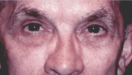After 4 Lid Eyelid Lift