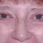 After 4 Lid Eyelid Lift