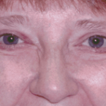 After 4 Lid Eyelid Lift