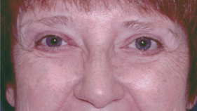 After 4 Lid Eyelid Lift