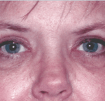 After 4 Lid Eyelid Lift