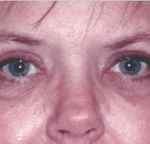 After 4 Lid Eyelid Lift