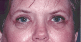 After 4 Lid Eyelid Lift