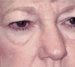 Before 4 Lid Eyelid Lift