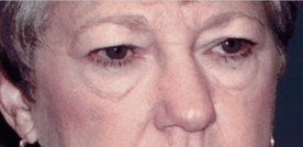 Before 4 Lid Eyelid Lift