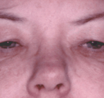 Before 4 Lid Eyelid Lift