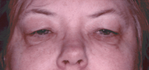 Before 4 Lid Eyelid Lift