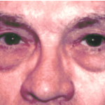 Before 4 Lid Eyelid Lift