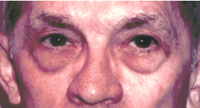 Before 4 Lid Eyelid Lift