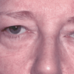 Before 4 Lid Eyelid Lift