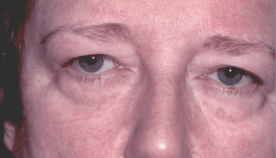 Before 4 Lid Eyelid Lift