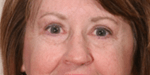 After 4 Lid Eyelid Lift