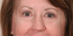 After 4 Lid Eyelid Lift