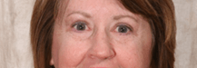 After 4 Lid Eyelid Lift