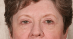 After 4 Lid Eyelid Lift