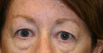 Before 4 Lid Eyelid Lift