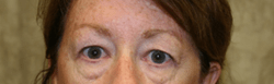 Before 4 Lid Eyelid Lift