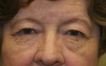 Before 4 Lid Eyelid Lift