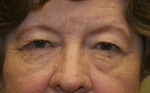Before 4 Lid Eyelid Lift