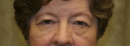 Before 4 Lid Eyelid Lift