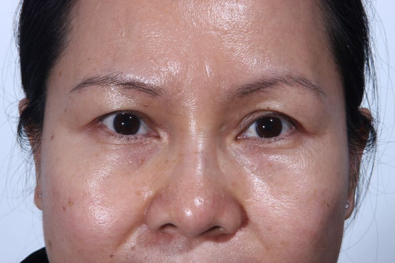 Before Upper Lid Lift