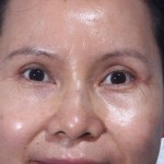 After Upper Lid Lift