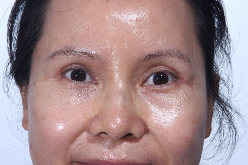 After Upper Lid Lift