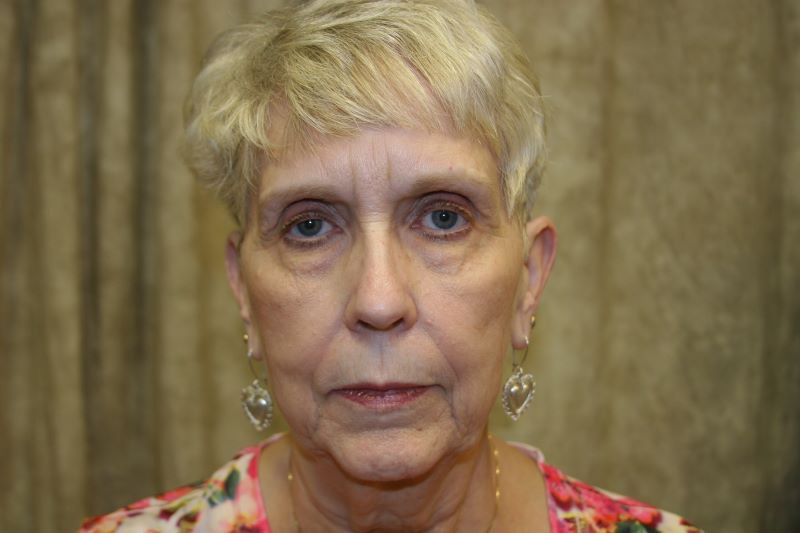 Before the correction of drooping eyelids
