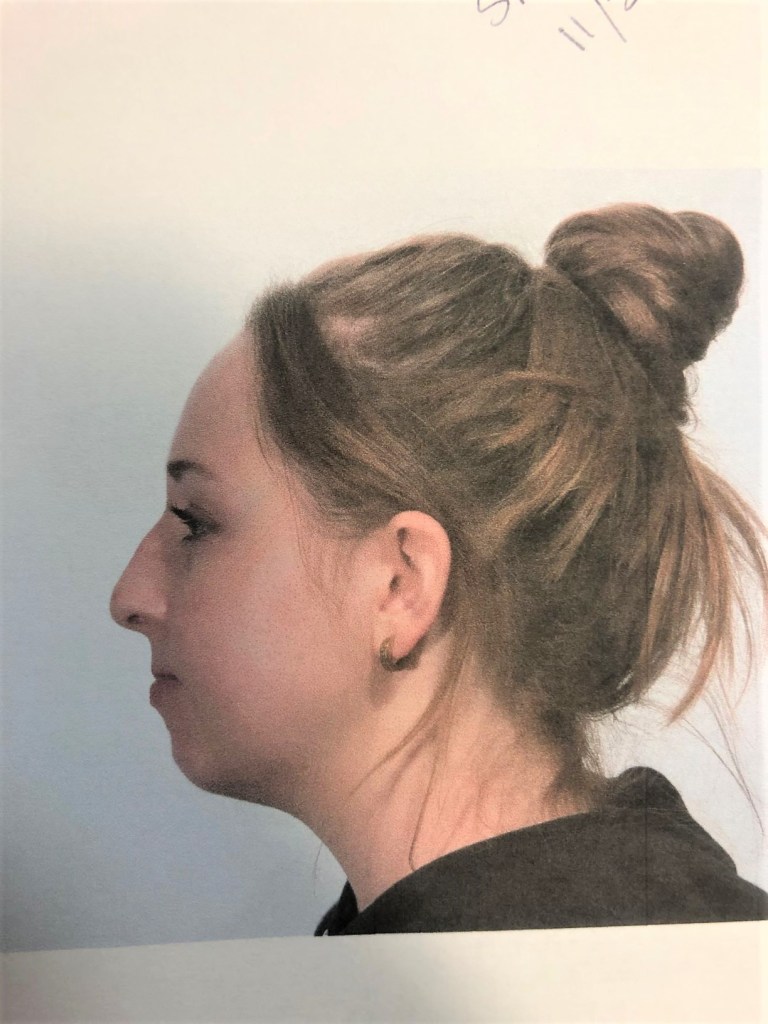 Before Bellafill